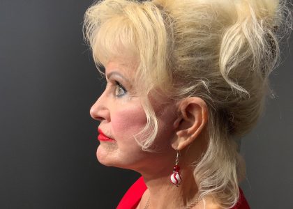Facelift Before & After Patient #4350