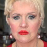 Facelift Before & After Patient #4350