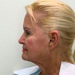 Facelift Before & After Patient #4350