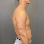 Male Breast Reduction Before & After Patient #4177