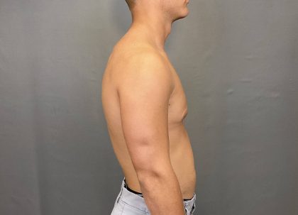 Male Breast Reduction Before & After Patient #4177