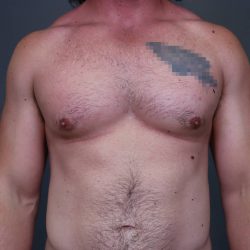 Male Breast Reduction Before & After Patient #4175