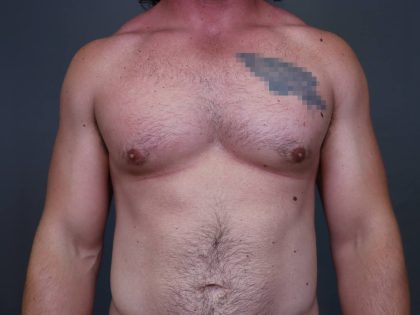 Male Breast Reduction Before & After Patient #4175