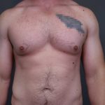 Male Breast Reduction Before & After Patient #4175