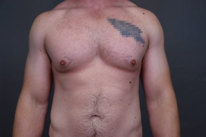 Male Breast Reduction Before & After Patient #4175