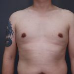 Male Breast Reduction Before & After Patient #4176