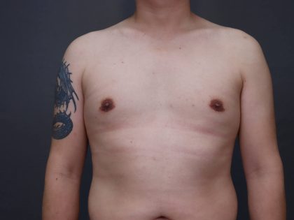 Male Breast Reduction Before & After Patient #4176