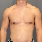 Male Breast Reduction Before & After Patient #4177