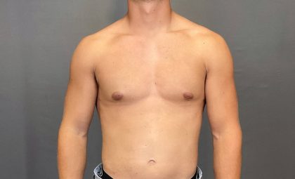 Male Breast Reduction Before & After Patient #4177