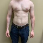 Male Breast Reduction Before & After Patient #4178
