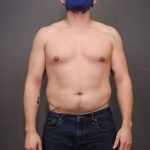 Male Breast Reduction Before & After Patient #4179