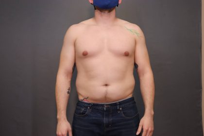 Male Breast Reduction Before & After Patient #4179