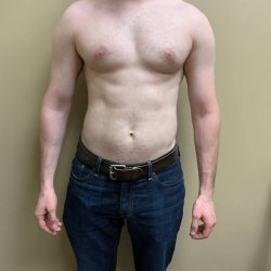 Male Breast Reduction Before & After Patient #4178