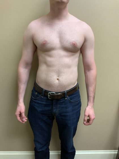 Male Breast Reduction Before & After Patient #4178