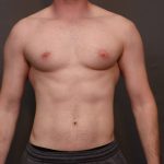 Male Breast Reduction Before & After Patient #4178