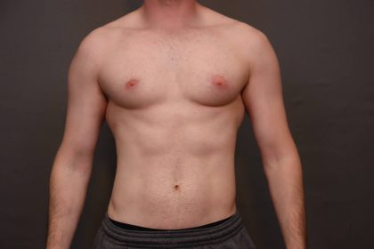 Male Breast Reduction Before & After Patient #4178
