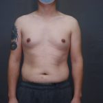 Male Breast Reduction Before & After Patient #4176