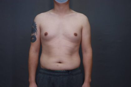 Male Breast Reduction Before & After Patient #4176