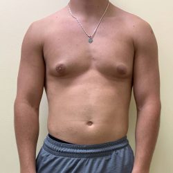 Male Breast Reduction Before & After Patient #4177