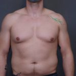 Male Breast Reduction Before & After Patient #4179