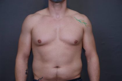 Male Breast Reduction Before & After Patient #4179