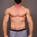 Male Breast Reduction Before & After Patient #4180