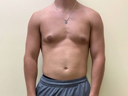 Male Breast Reduction Before & After Patient #4177