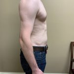 Male Breast Reduction Before & After Patient #4178