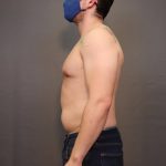 Male Breast Reduction Before & After Patient #4179