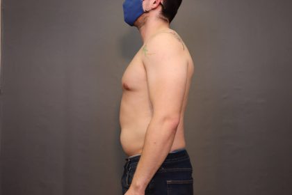 Male Breast Reduction Before & After Patient #4179