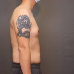 Male Breast Reduction Before & After Patient #4176