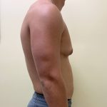 Male Breast Reduction Before & After Patient #4177