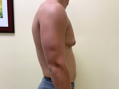 Male Breast Reduction Before & After Patient #4177