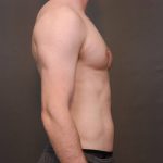 Male Breast Reduction Before & After Patient #4178
