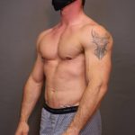 Male Breast Reduction Before & After Patient #4180