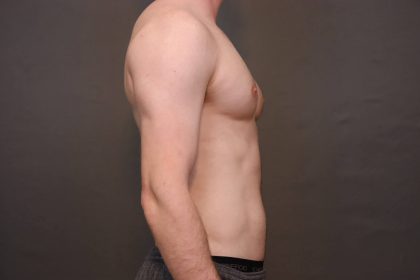 Male Breast Reduction Before & After Patient #4178