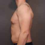 Male Breast Reduction Before & After Patient #4179