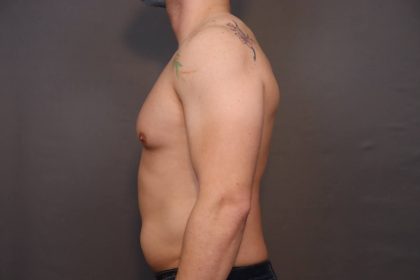 Male Breast Reduction Before & After Patient #4179