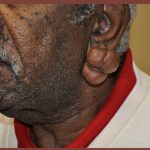Earlobe Repair Before & After Patient #3721