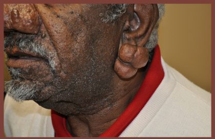Earlobe Repair Before & After Patient #3721