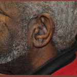 Earlobe Repair Before & After Patient #3721
