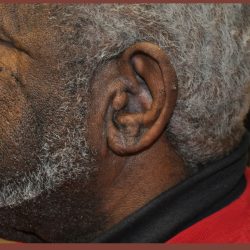 Earlobe Repair Before & After Patient #3721
