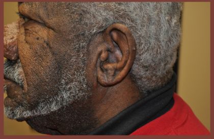 Earlobe Repair Before & After Patient #3721