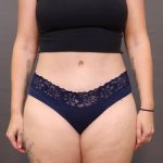 Liposuction Before & After Patient #4010