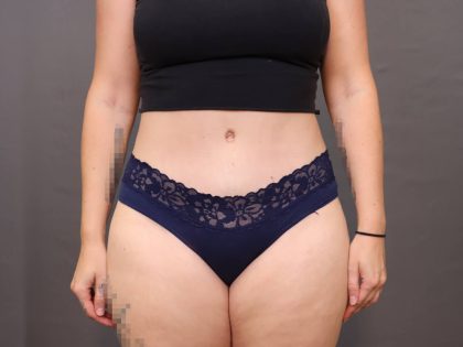 Liposuction Before & After Patient #4010