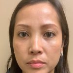 Blepharoplasty Before & After Patient #3595