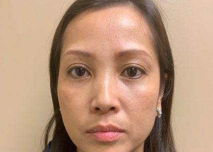 Blepharoplasty Before & After Patient #3595