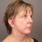 Neck Lift Before & After Patient #4347