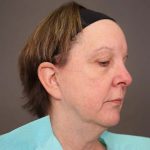 Neck Lift Before & After Patient #4347