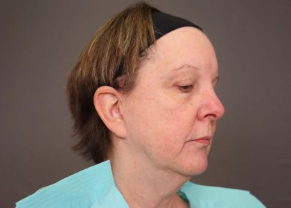 Neck Lift Before & After Patient #4347